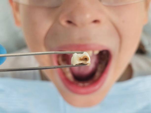 Best Urgent Care for Lost Fillings or Crowns in Troutman, NC